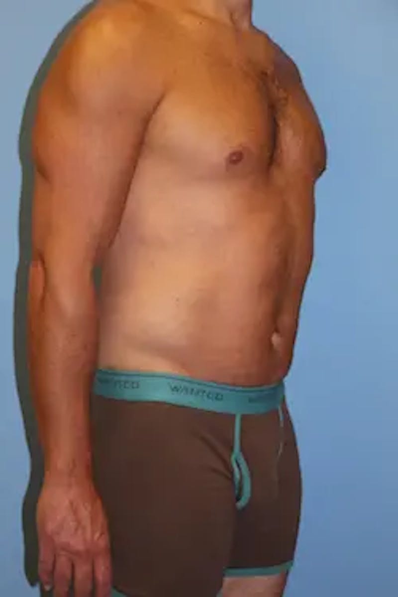 Liposuction Before & After Gallery - Patient 146968 - Image 4