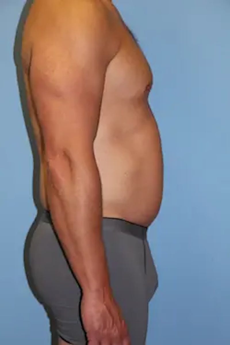 Liposuction Before & After Gallery - Patient 146968 - Image 5