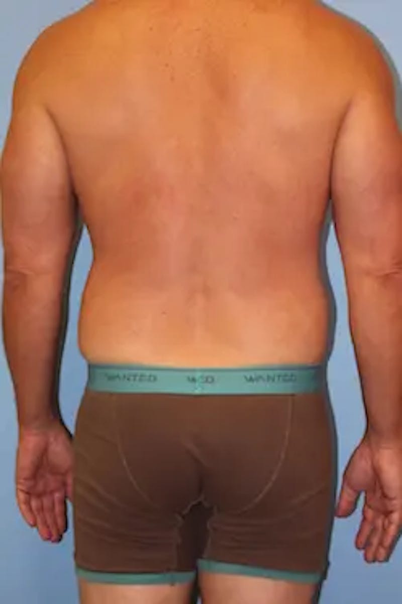 Liposuction Before & After Gallery - Patient 146968 - Image 8