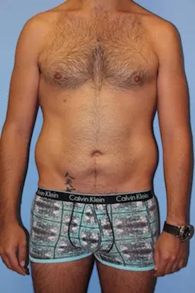 Liposuction Before & After Gallery - Patient 164756 - Image 1