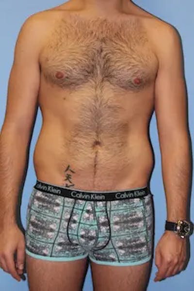 Liposuction Before & After Gallery - Patient 164756 - Image 2
