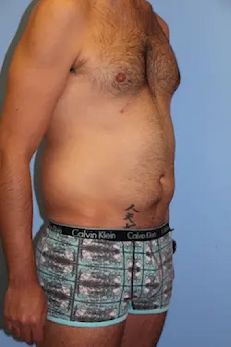 Liposuction Before & After Gallery - Patient 164756 - Image 3