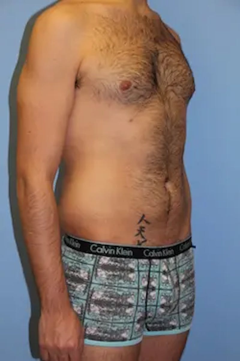 Liposuction Before & After Gallery - Patient 164756 - Image 4