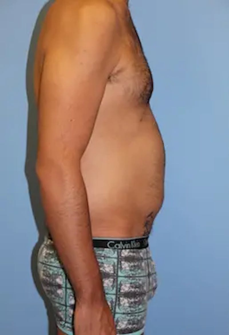 Liposuction Before & After Gallery - Patient 164756 - Image 5
