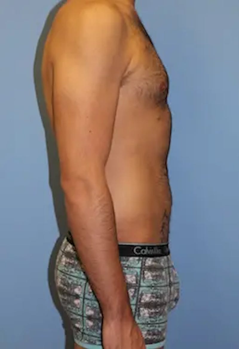 Liposuction Before & After Gallery - Patient 164756 - Image 6