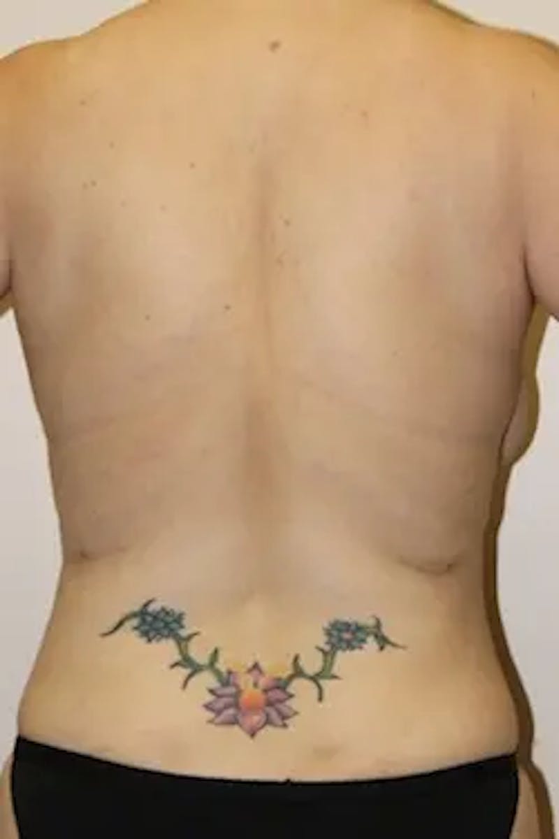 Liposuction Before & After Gallery - Patient 173697 - Image 6
