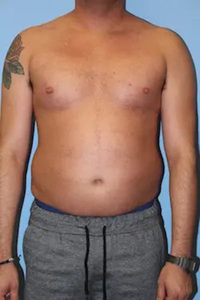 Liposuction Before & After Gallery - Patient 277520 - Image 1