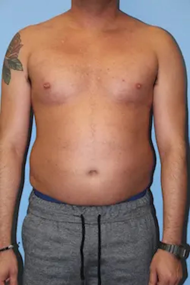 Liposuction Before & After Gallery - Patient 277520 - Image 1