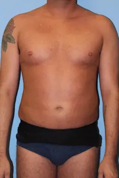 Liposuction Before & After Gallery - Patient 277520 - Image 2