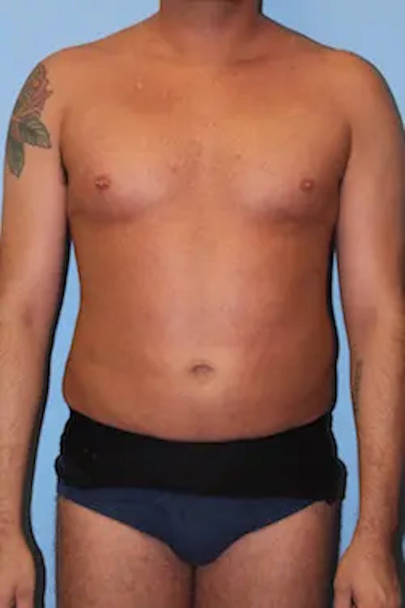 Liposuction Before & After Gallery - Patient 277520 - Image 2