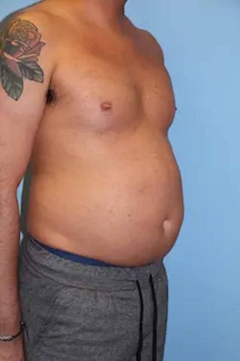 Liposuction Before & After Gallery - Patient 277520 - Image 3