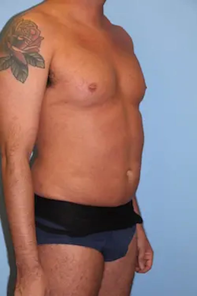 Liposuction Before & After Gallery - Patient 277520 - Image 4