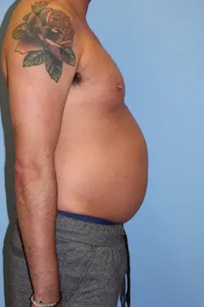 Liposuction Before & After Gallery - Patient 277520 - Image 5