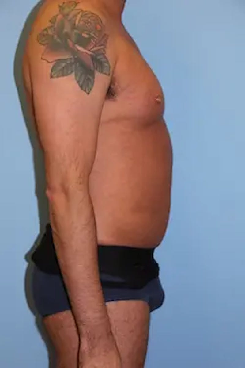 Liposuction Before & After Gallery - Patient 277520 - Image 6