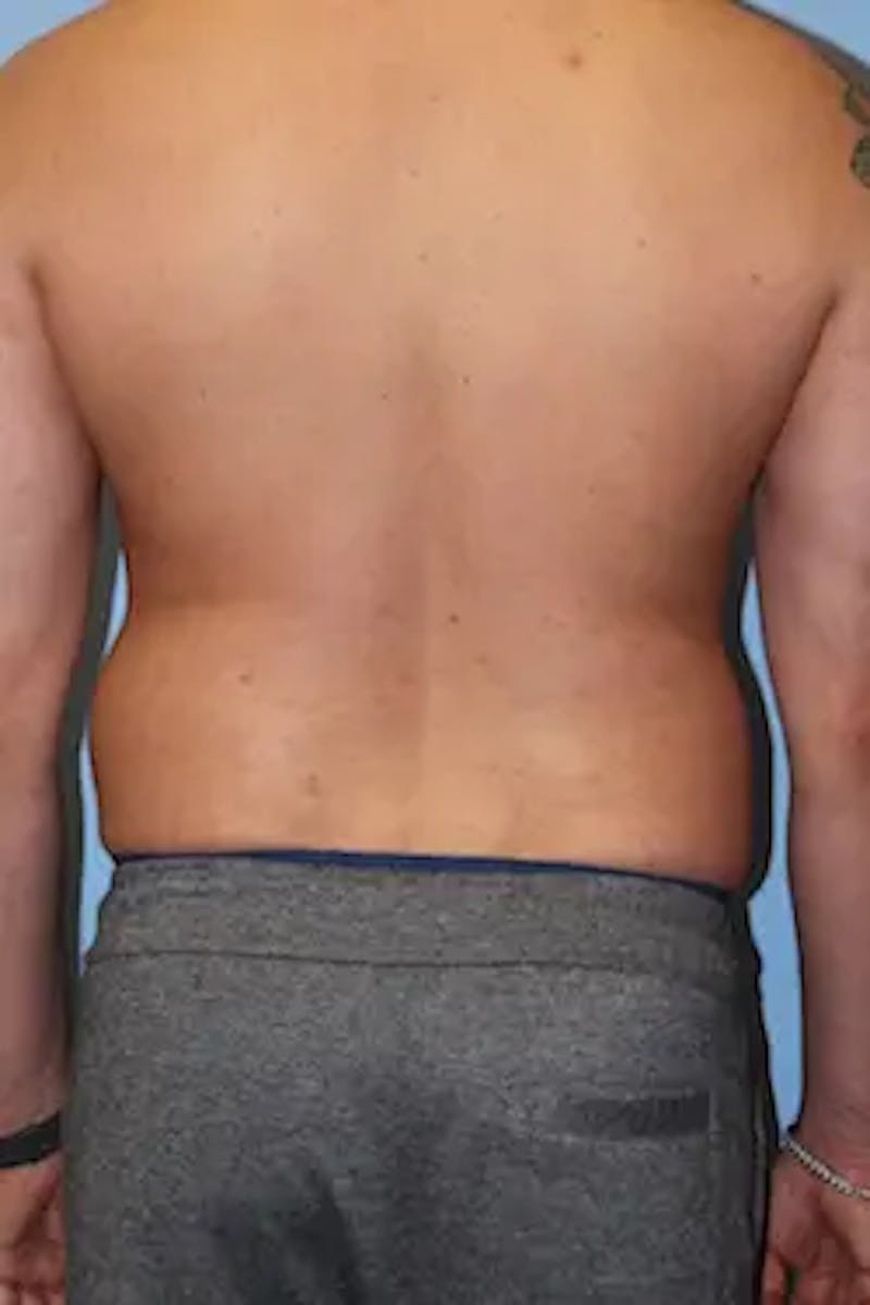 Liposuction Before & After Gallery - Patient 277520 - Image 7