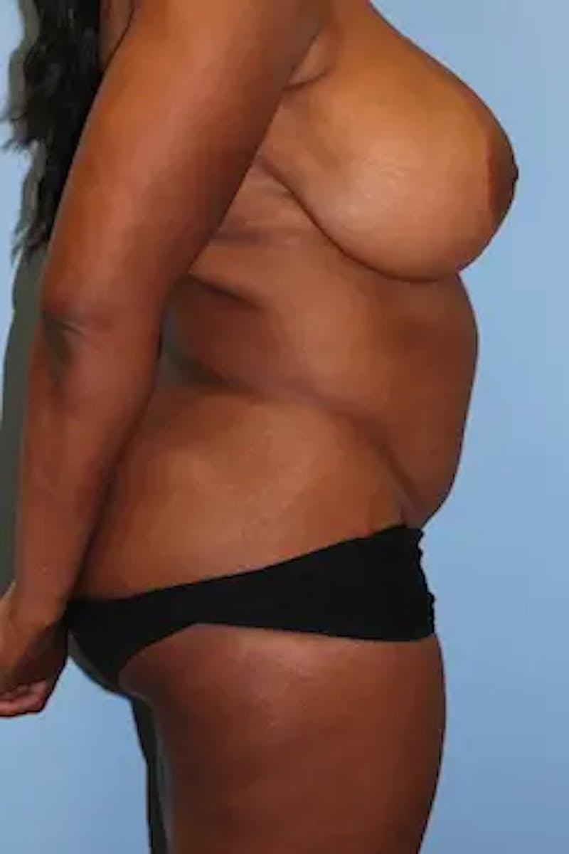 Liposuction Before & After Gallery - Patient 396151 - Image 5