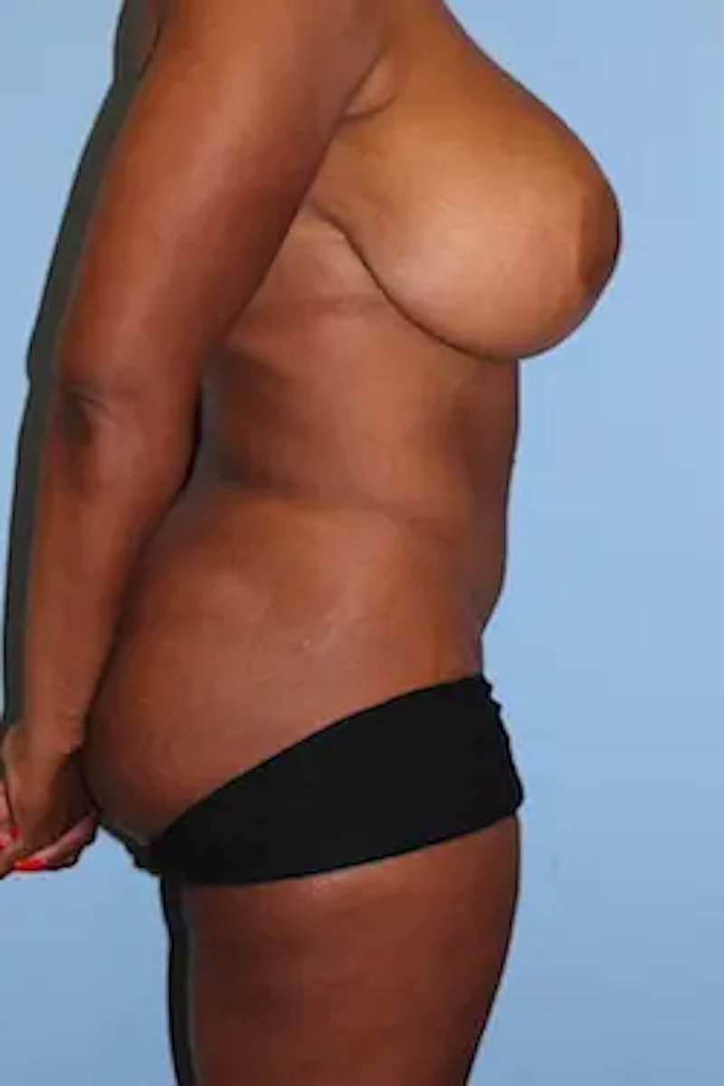 Liposuction Before & After Gallery - Patient 396151 - Image 6