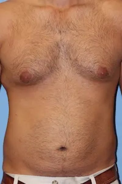 Liposuction Before & After Gallery - Patient 380028 - Image 1