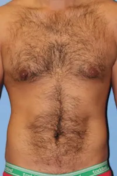 Liposuction Before & After Gallery - Patient 380028 - Image 2