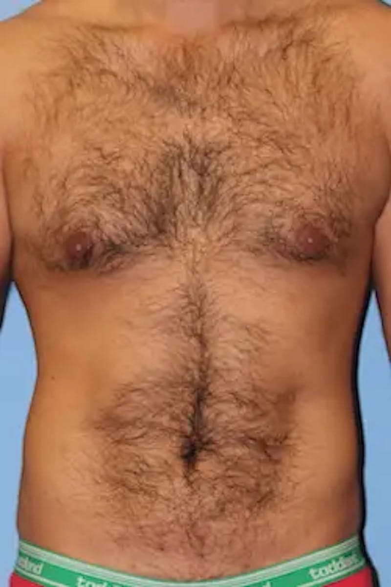 Liposuction Before & After Gallery - Patient 380028 - Image 2