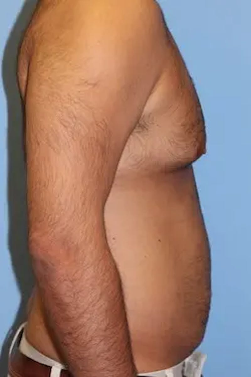 Liposuction Before & After Gallery - Patient 380028 - Image 5