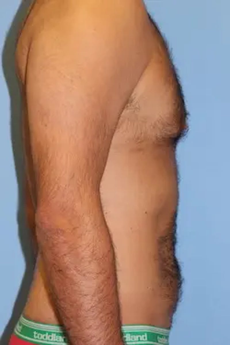 Liposuction Before & After Gallery - Patient 380028 - Image 6