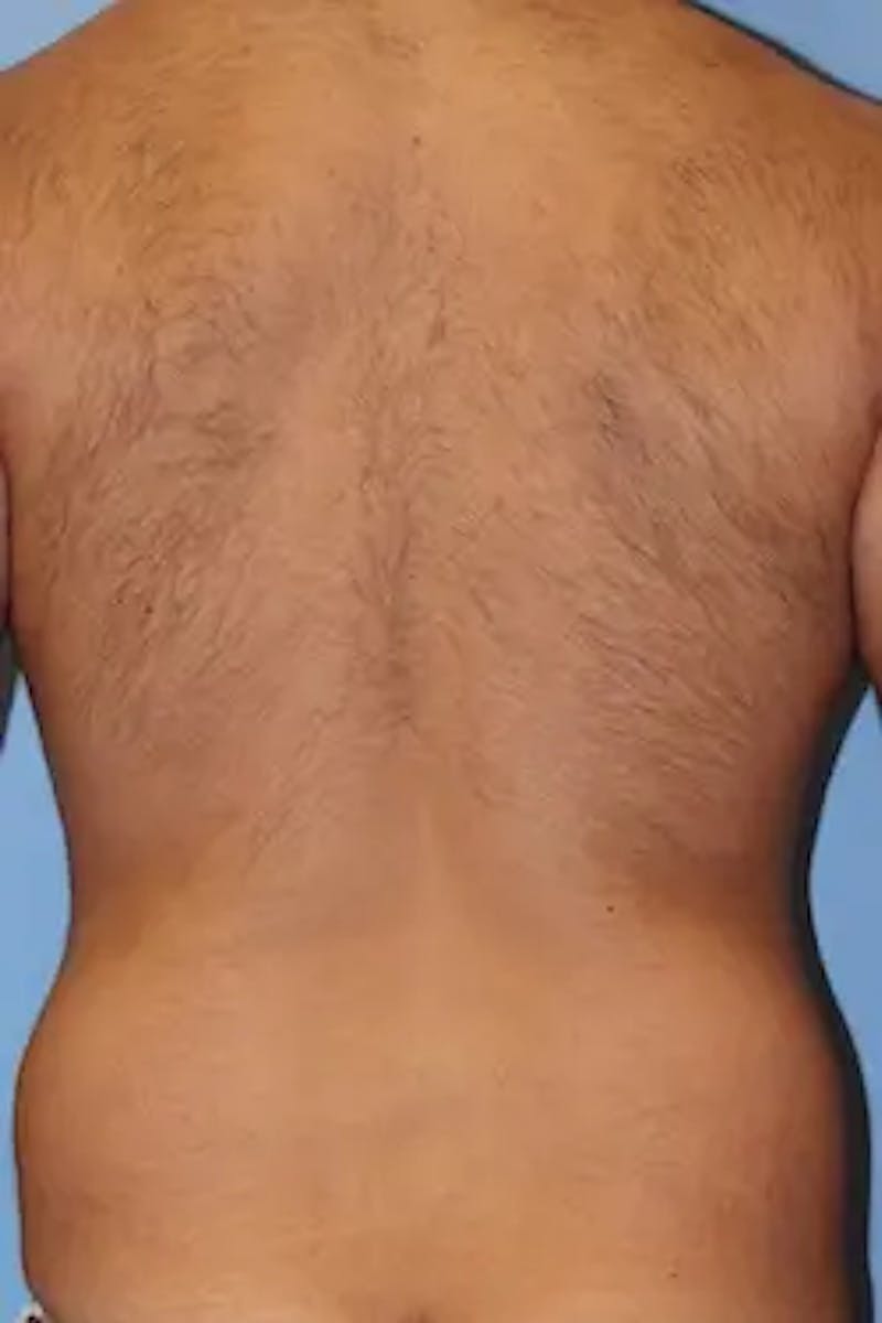 Liposuction Before & After Gallery - Patient 380028 - Image 7
