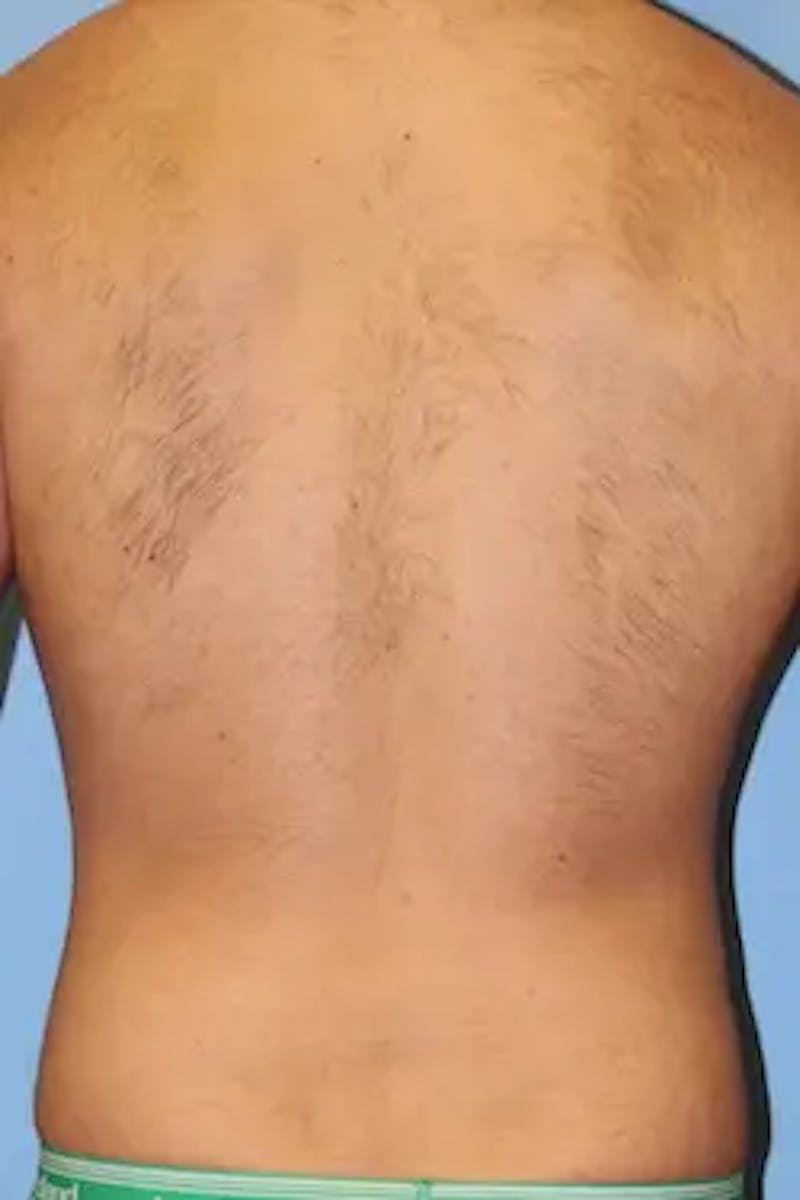 Liposuction Before & After Gallery - Patient 380028 - Image 8