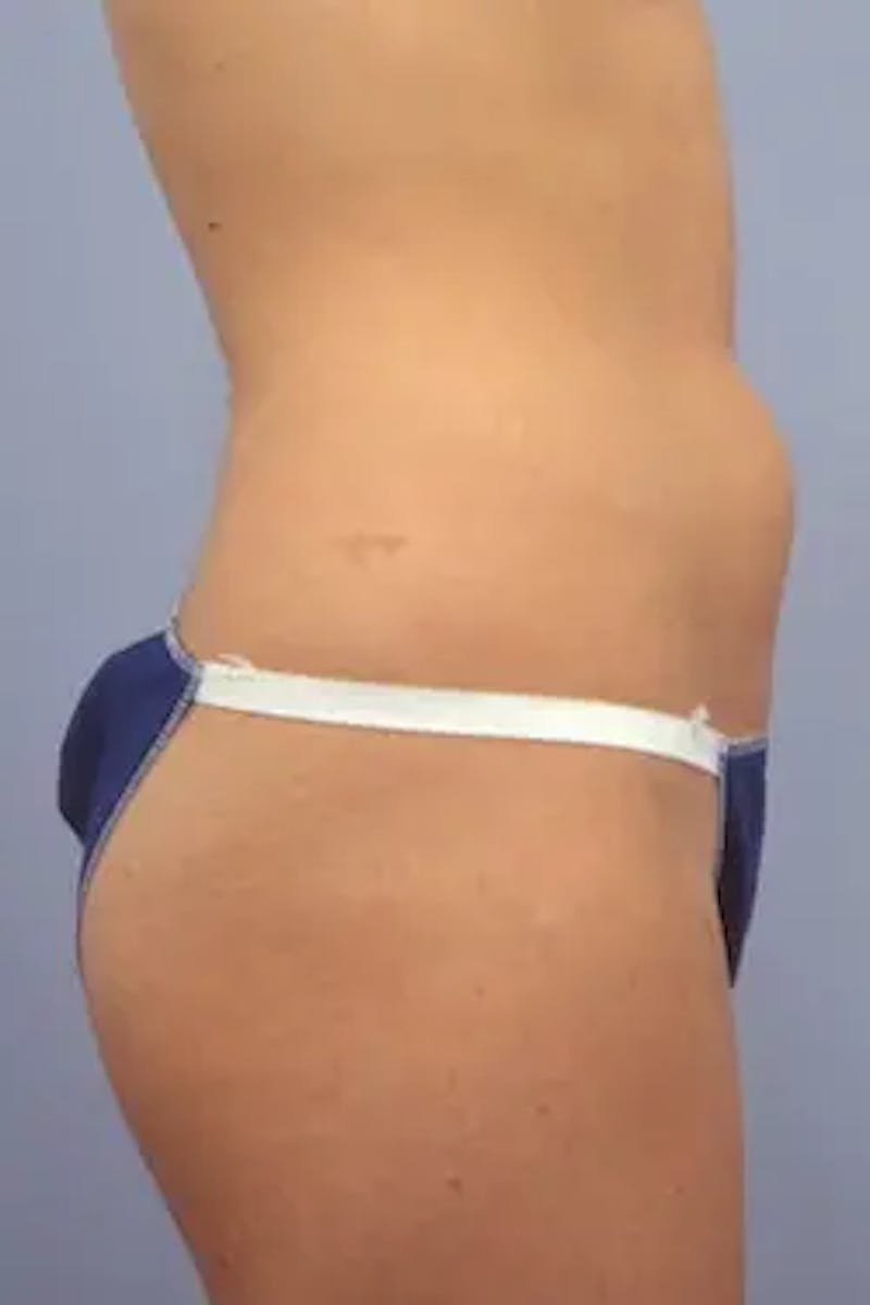 Liposuction Before & After Gallery - Patient 918996 - Image 5
