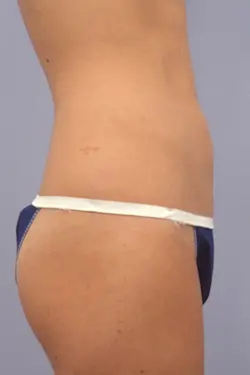 Liposuction Before & After Gallery - Patient 918996 - Image 6