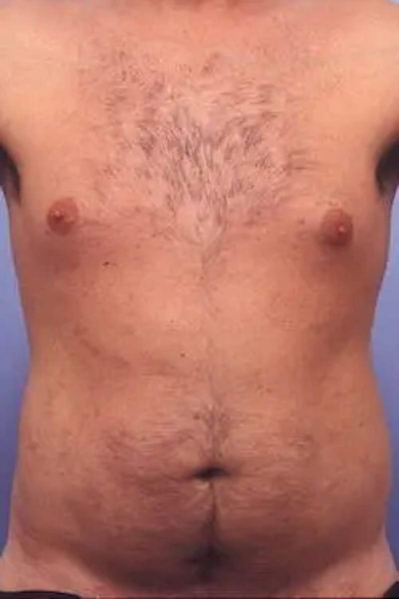 Liposuction Before & After Gallery - Patient 164680 - Image 1