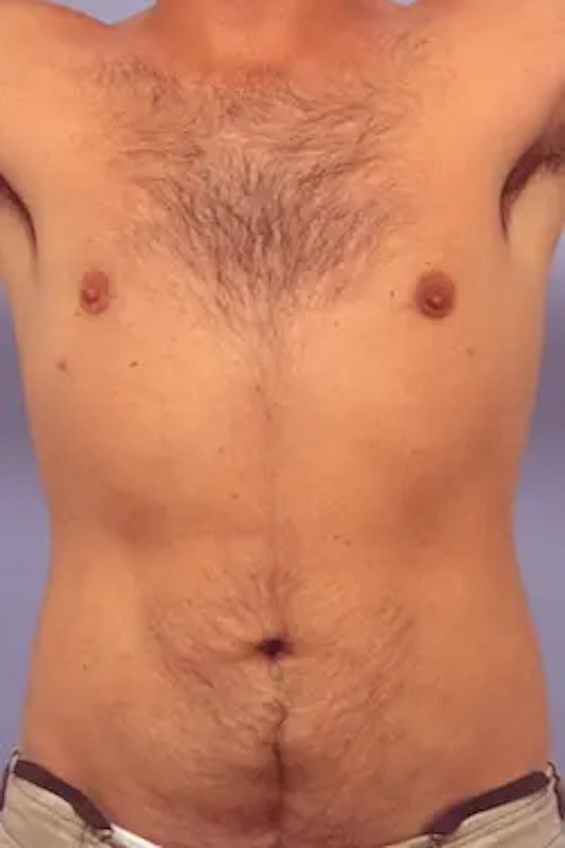 Liposuction Before & After Gallery - Patient 164680 - Image 2