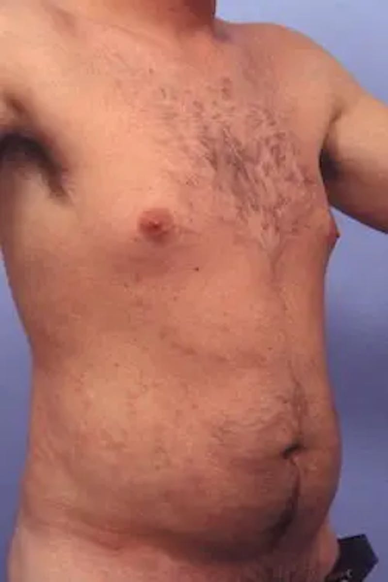 Liposuction Before & After Gallery - Patient 164680 - Image 3