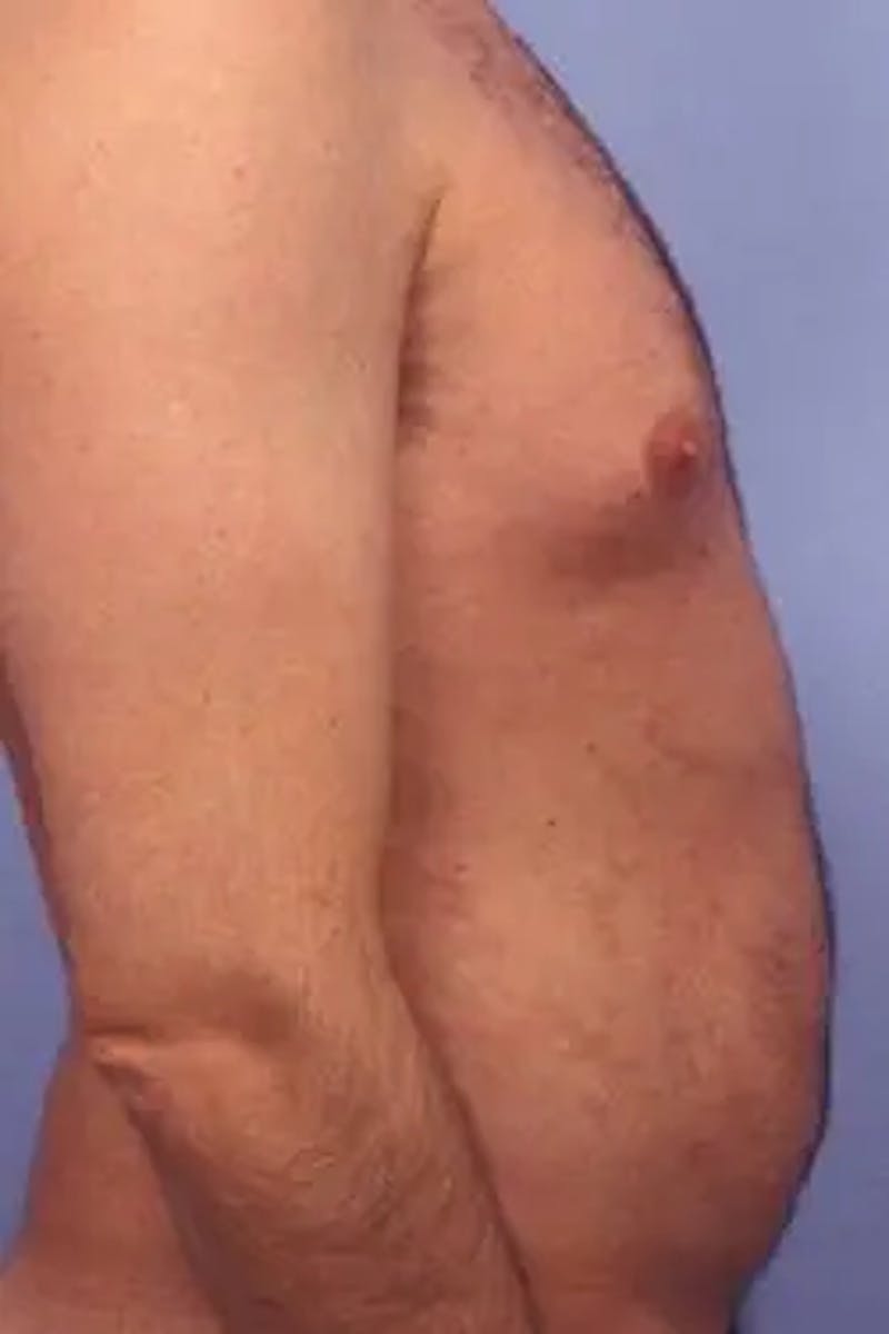 Liposuction Before & After Gallery - Patient 164680 - Image 5