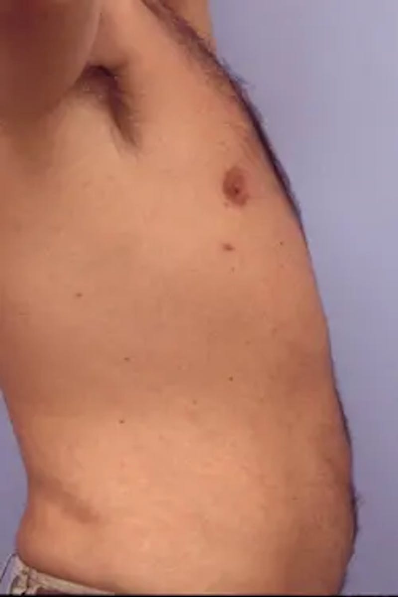 Liposuction Before & After Gallery - Patient 164680 - Image 6