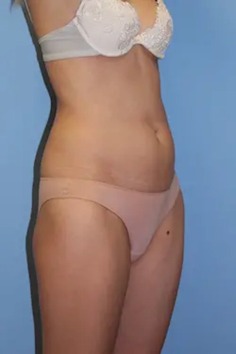 Liposuction Before & After Gallery - Patient 202222 - Image 3