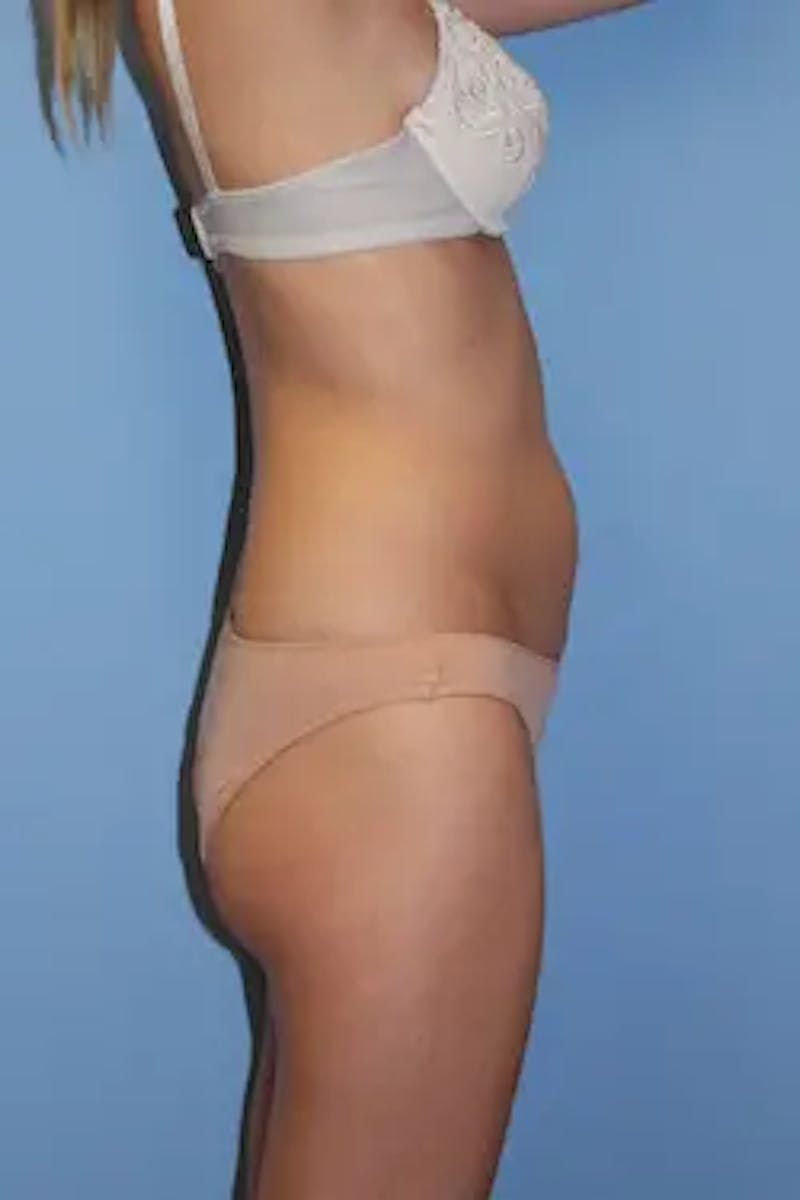 Liposuction Before & After Gallery - Patient 202222 - Image 5