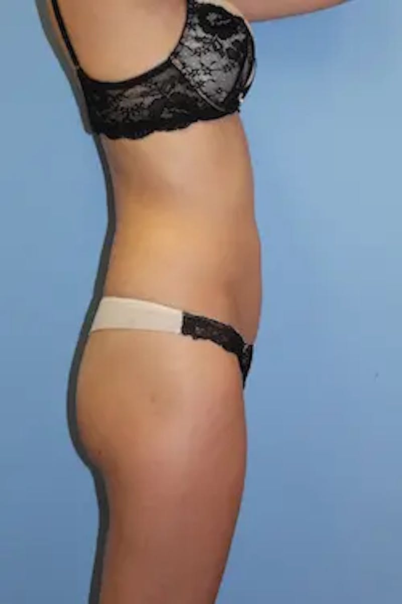 Liposuction Before & After Gallery - Patient 202222 - Image 6