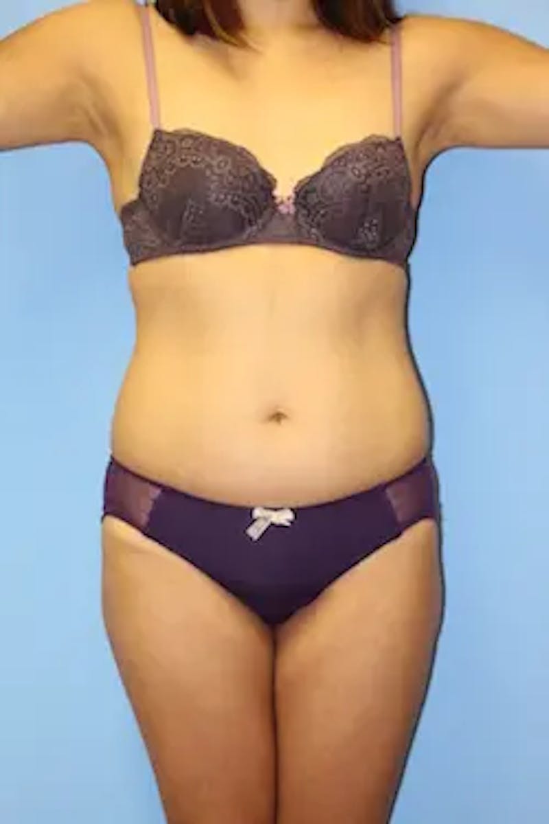 Liposuction Before & After Gallery - Patient 381526 - Image 1
