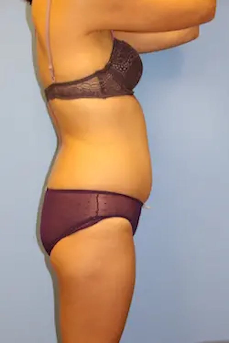 Liposuction Before & After Gallery - Patient 381526 - Image 5