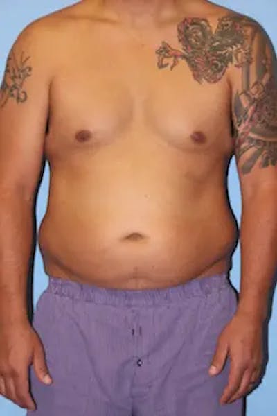 Liposuction Before & After Gallery - Patient 119404 - Image 1
