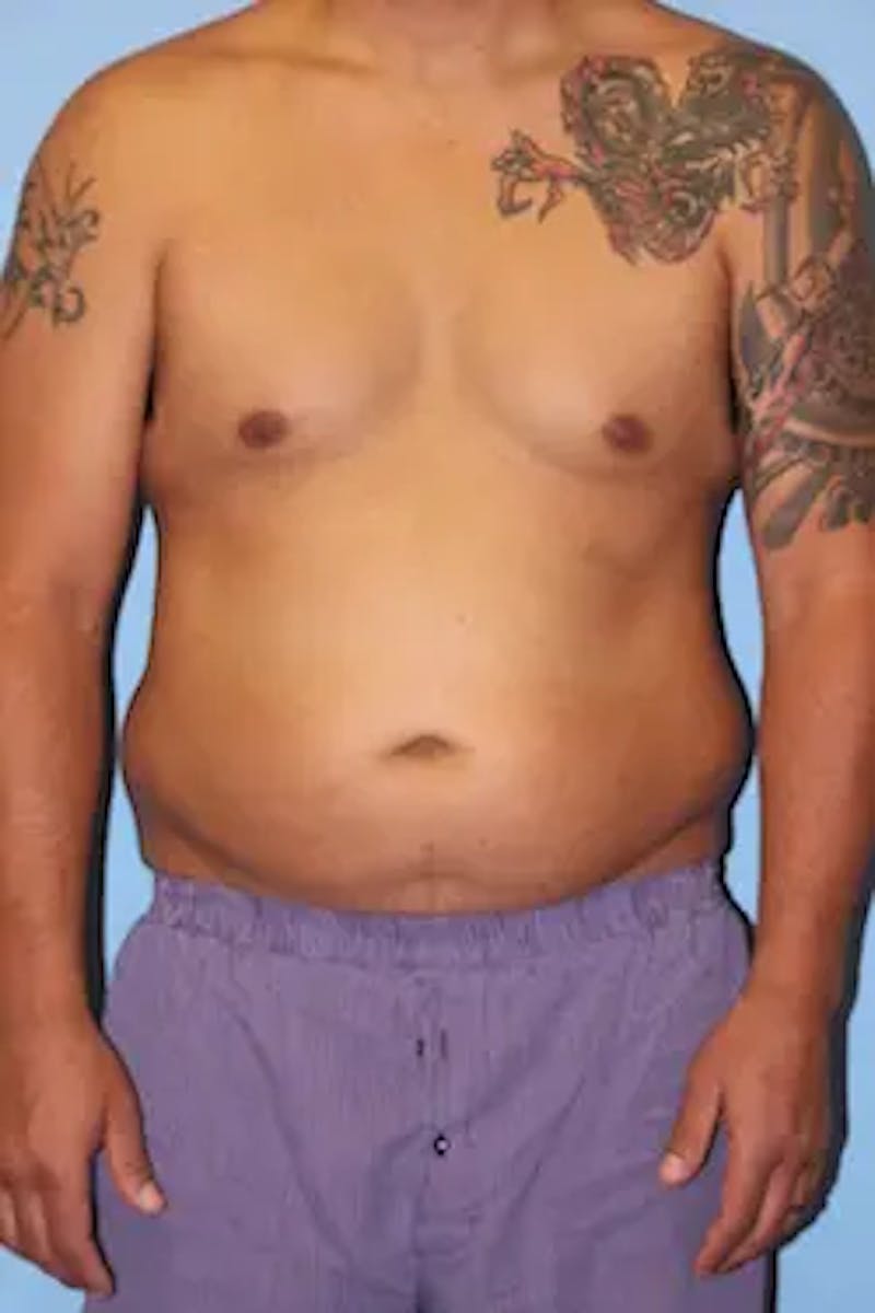 Liposuction Before & After Gallery - Patient 119404 - Image 1