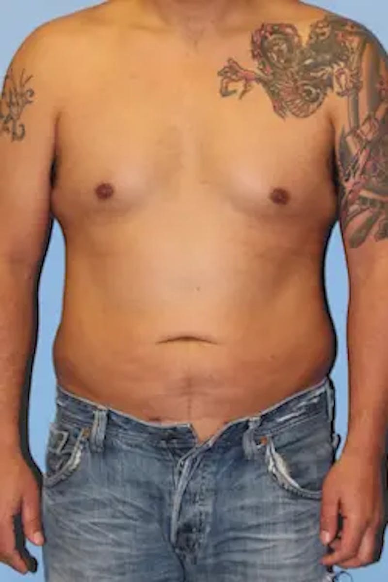 Liposuction Before & After Gallery - Patient 119404 - Image 2