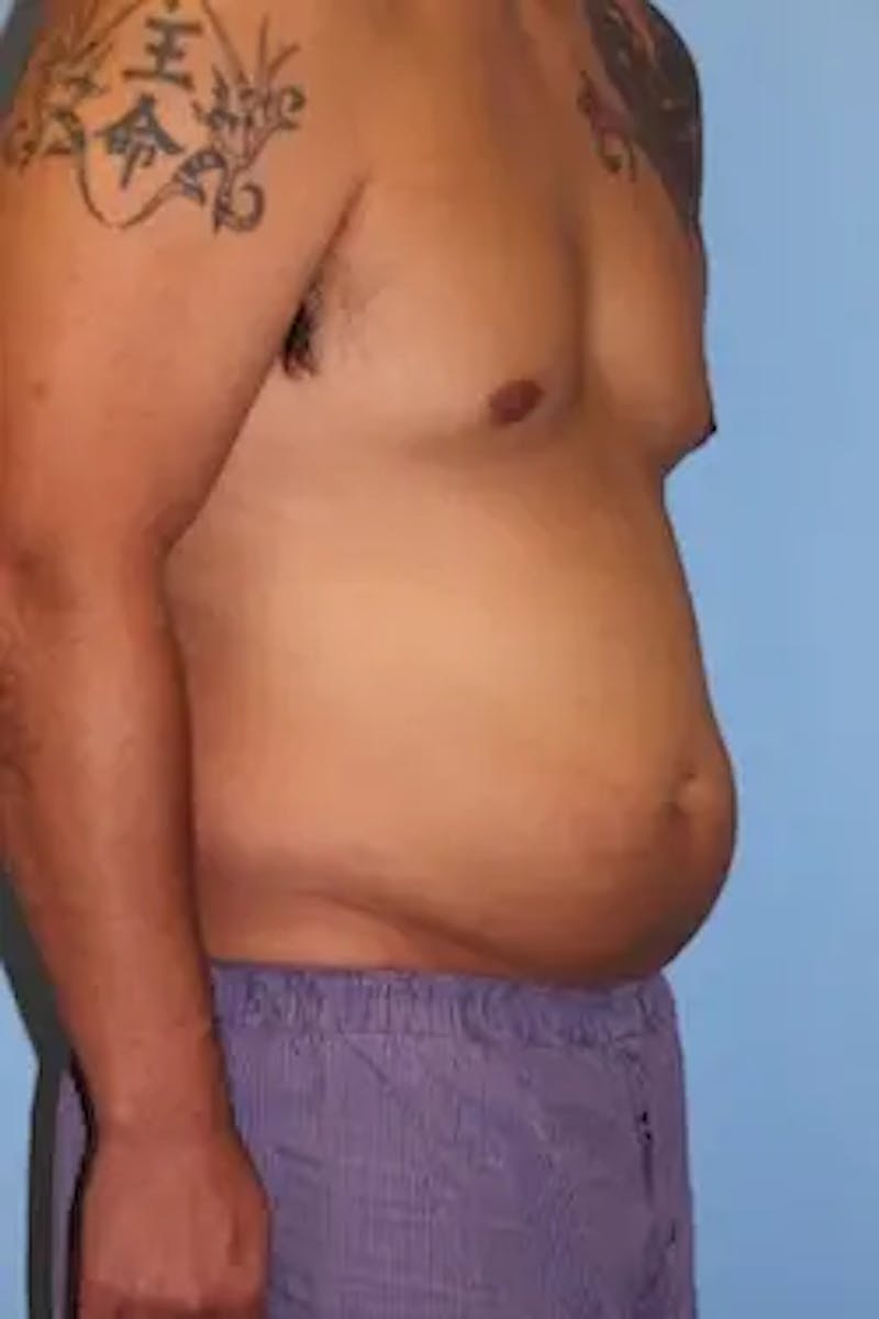 Liposuction Before & After Gallery - Patient 119404 - Image 3