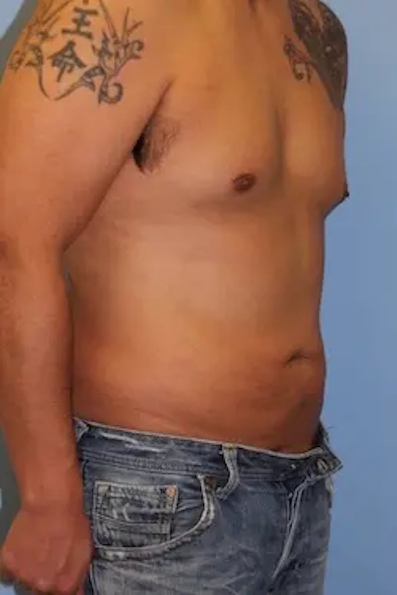 Liposuction Before & After Gallery - Patient 119404 - Image 4