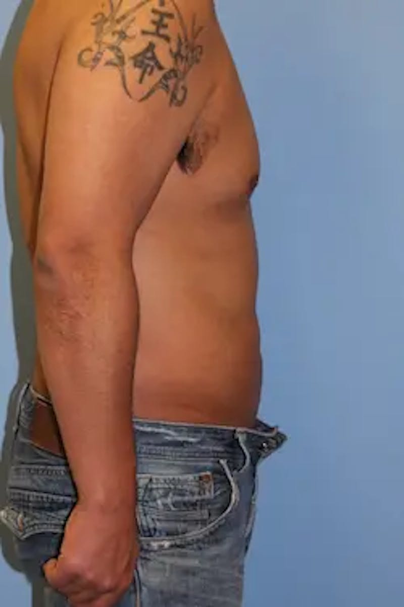 Liposuction Before & After Gallery - Patient 119404 - Image 6