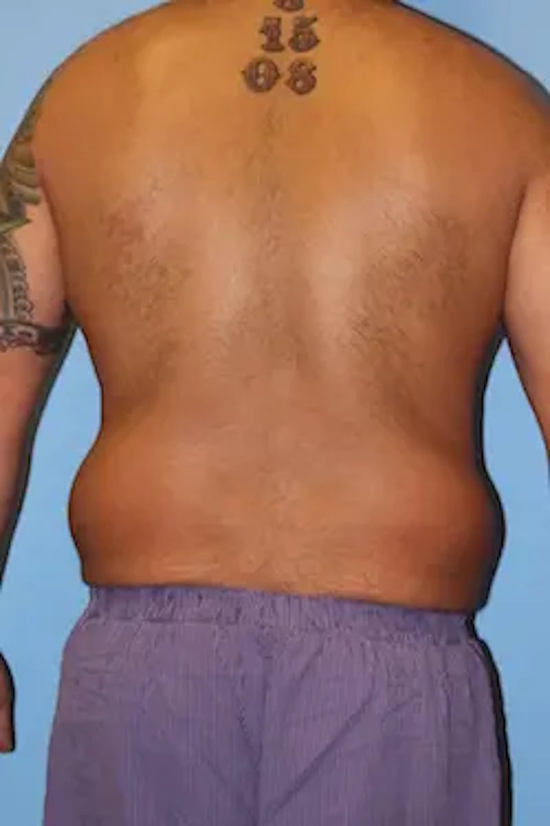 Liposuction Before & After Gallery - Patient 119404 - Image 7