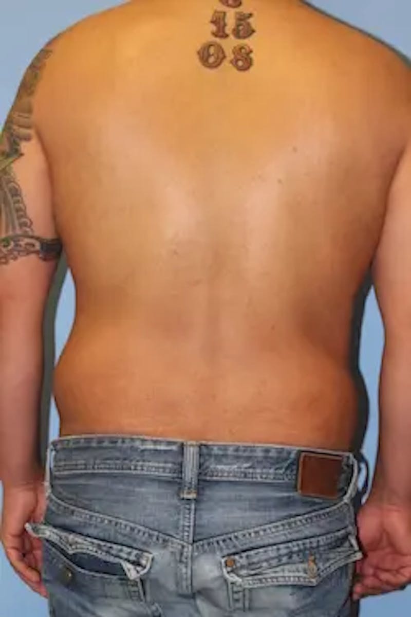 Liposuction Before & After Gallery - Patient 119404 - Image 8