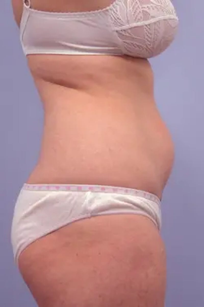 Liposuction Before & After Gallery - Patient 149529 - Image 5