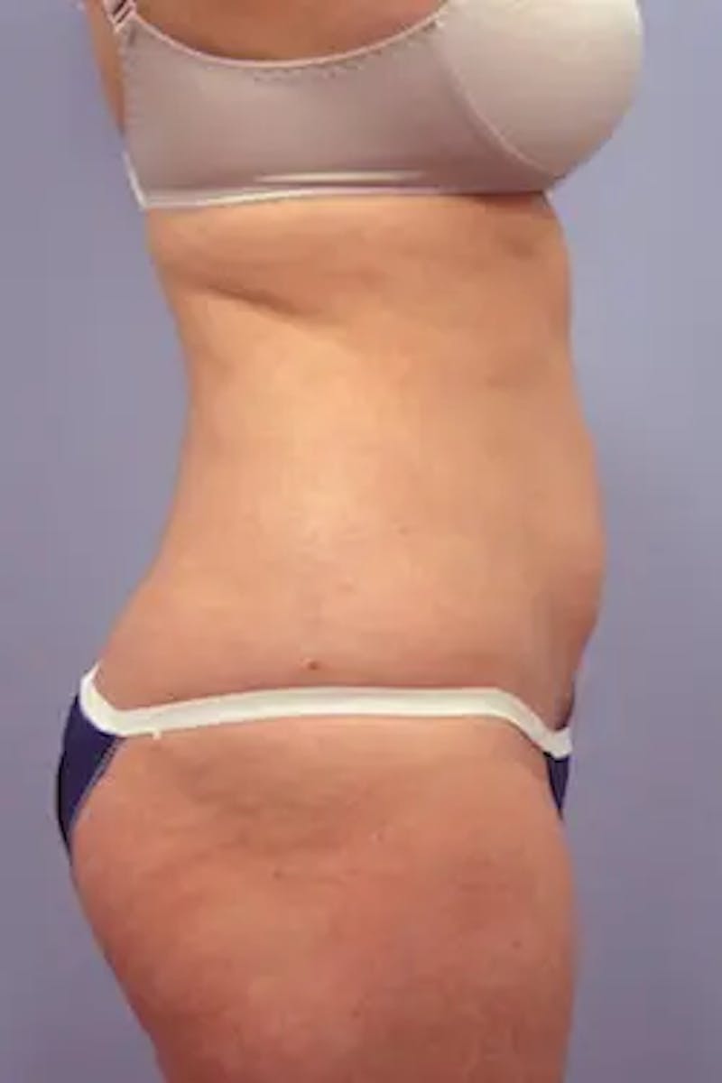 Liposuction Before & After Gallery - Patient 149529 - Image 6